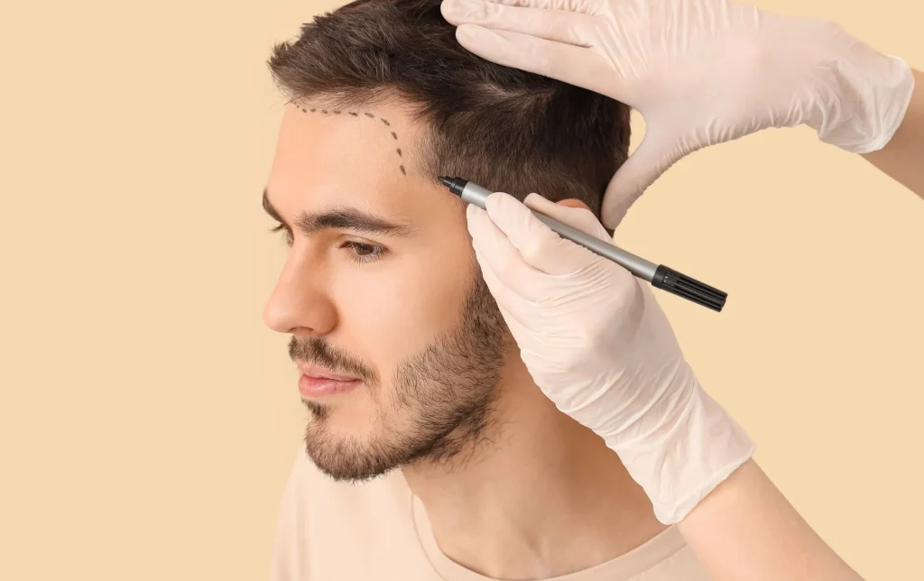 Le prix greffe de cheveux n’est pas le seul critère, la compétence compte aussi