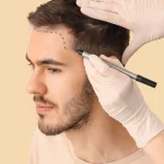Le prix greffe de cheveux n’est pas le seul critère, la compétence compte aussi